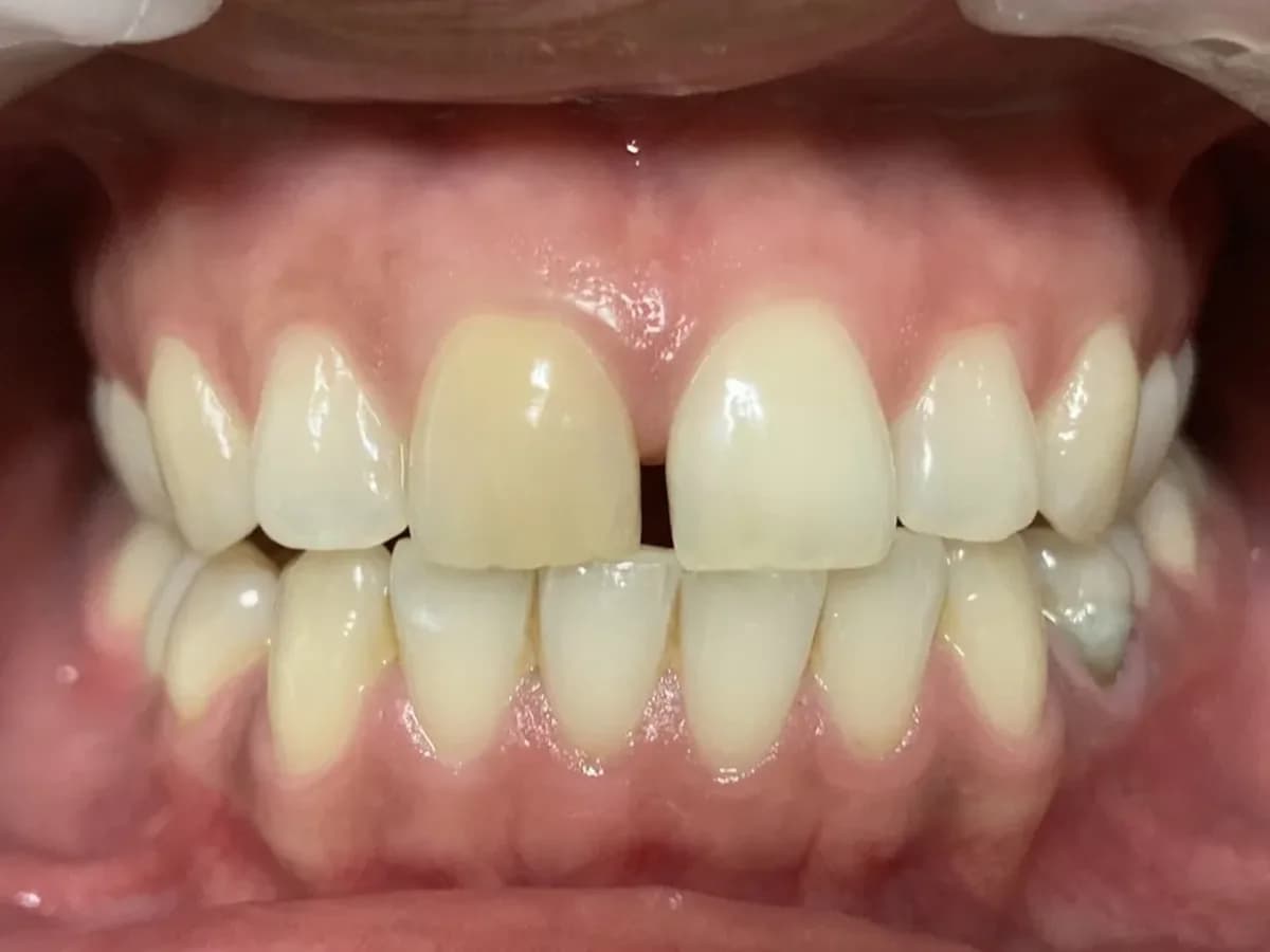 Branqueamento de um dente — Antes