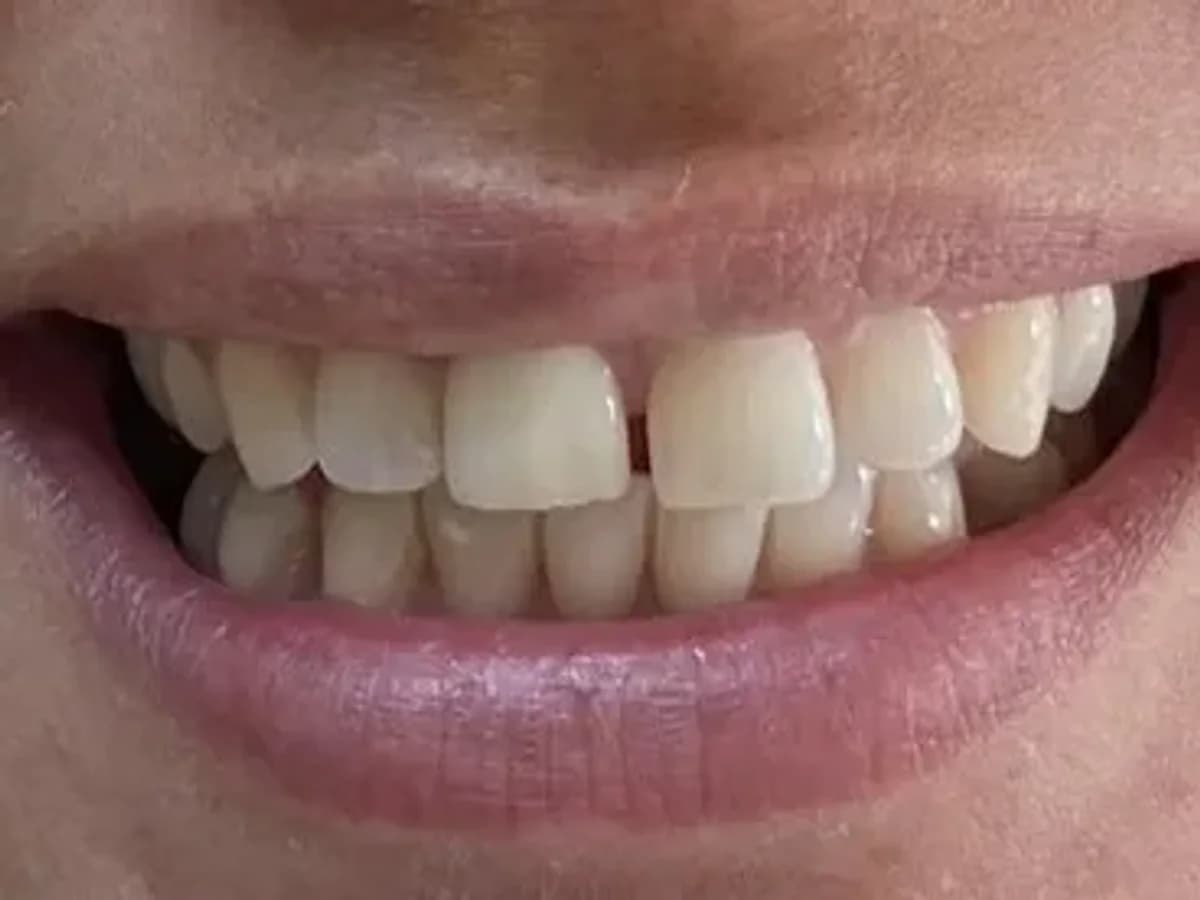 Branqueamento de um dente — Depois
