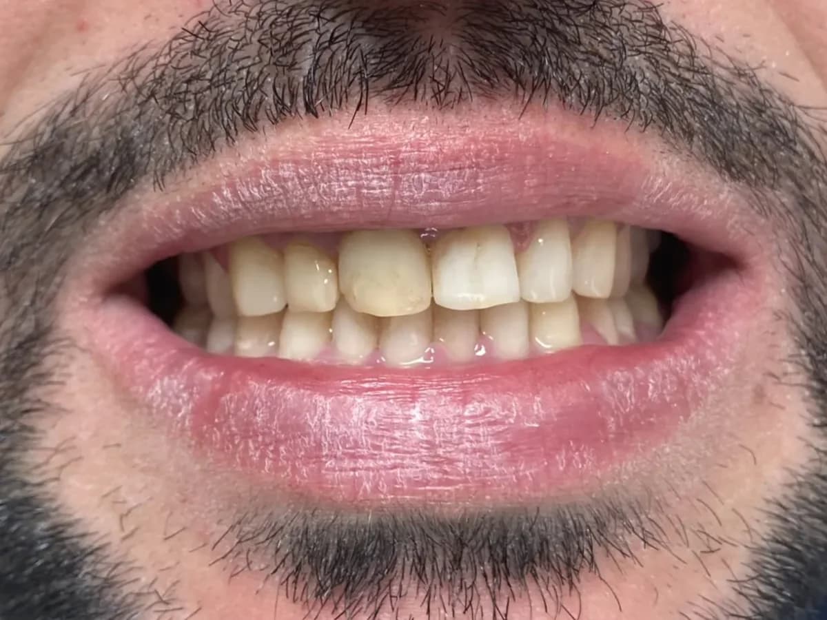 Desenho de sorriso com facetas — Antes