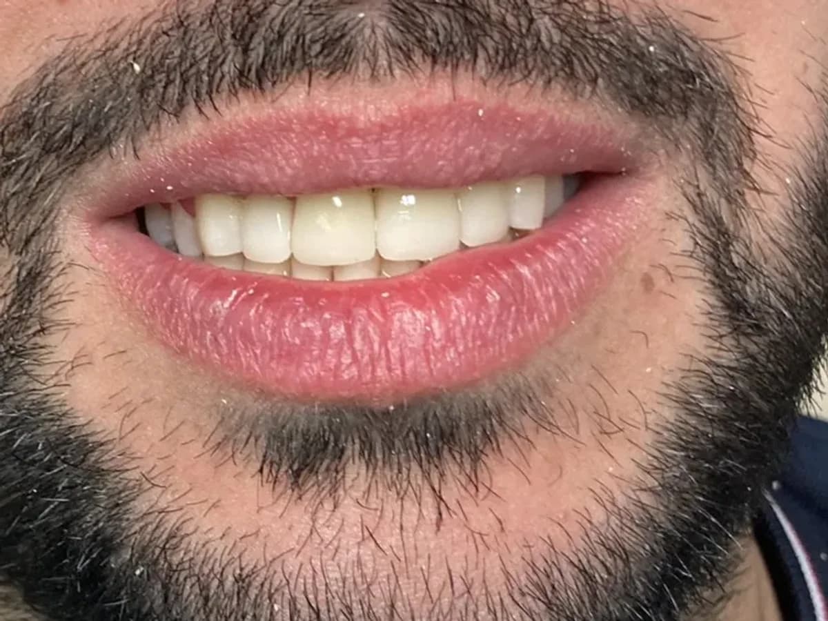 Desenho de sorriso com facetas — Depois