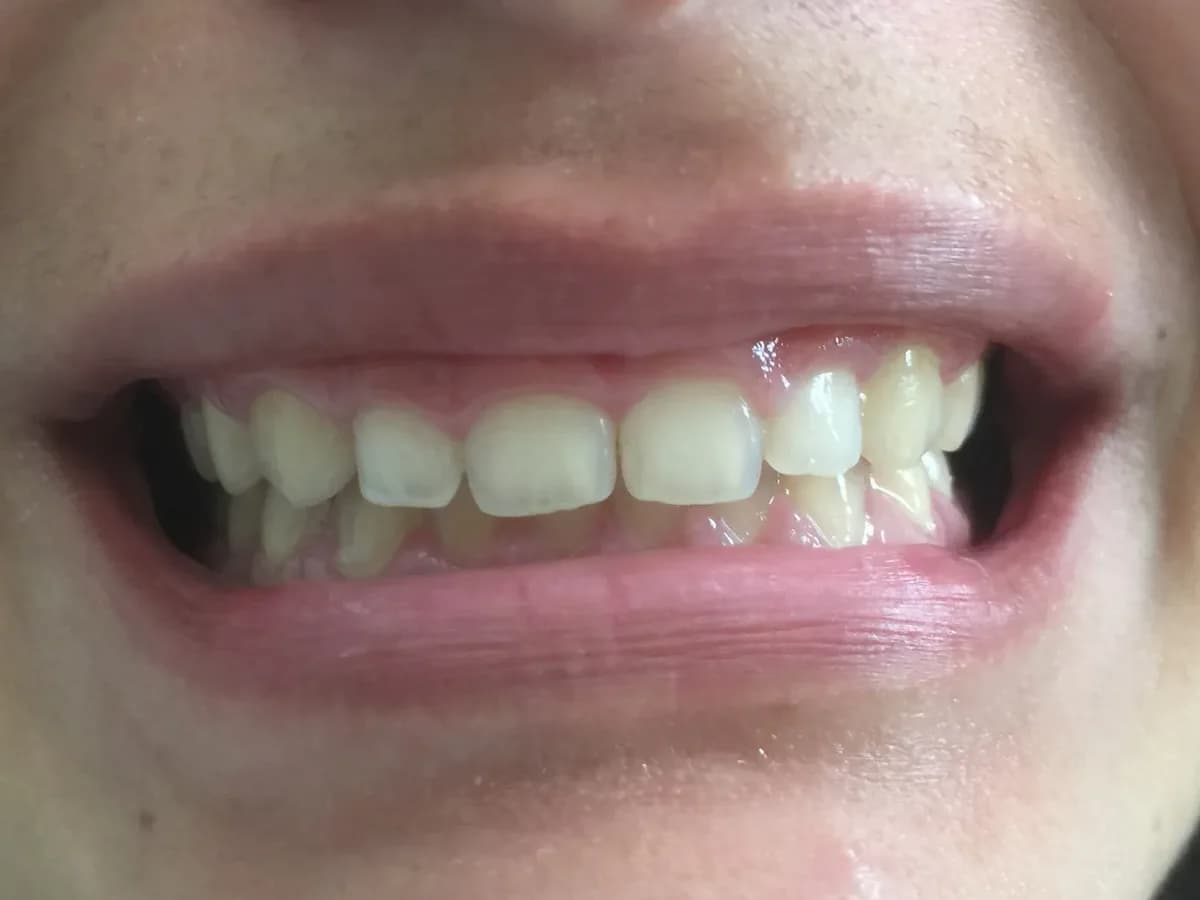 Correção de sorriso gengival — Antes