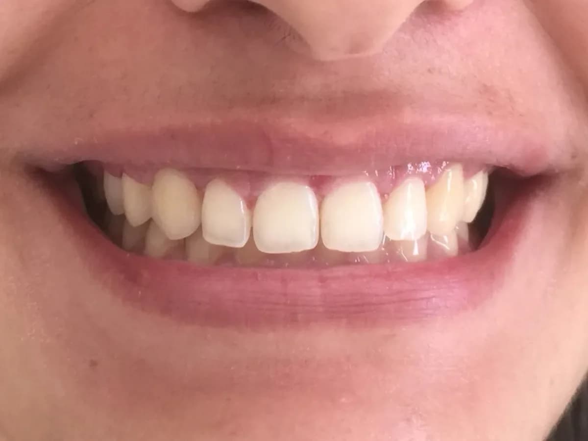 Correção de sorriso gengival — Depois