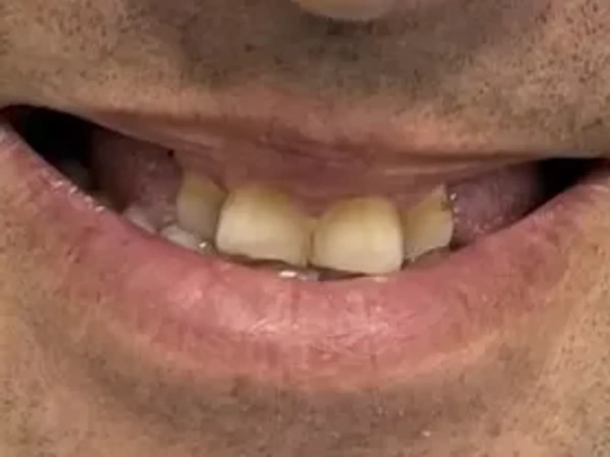Reabilitação com implantes — Antes