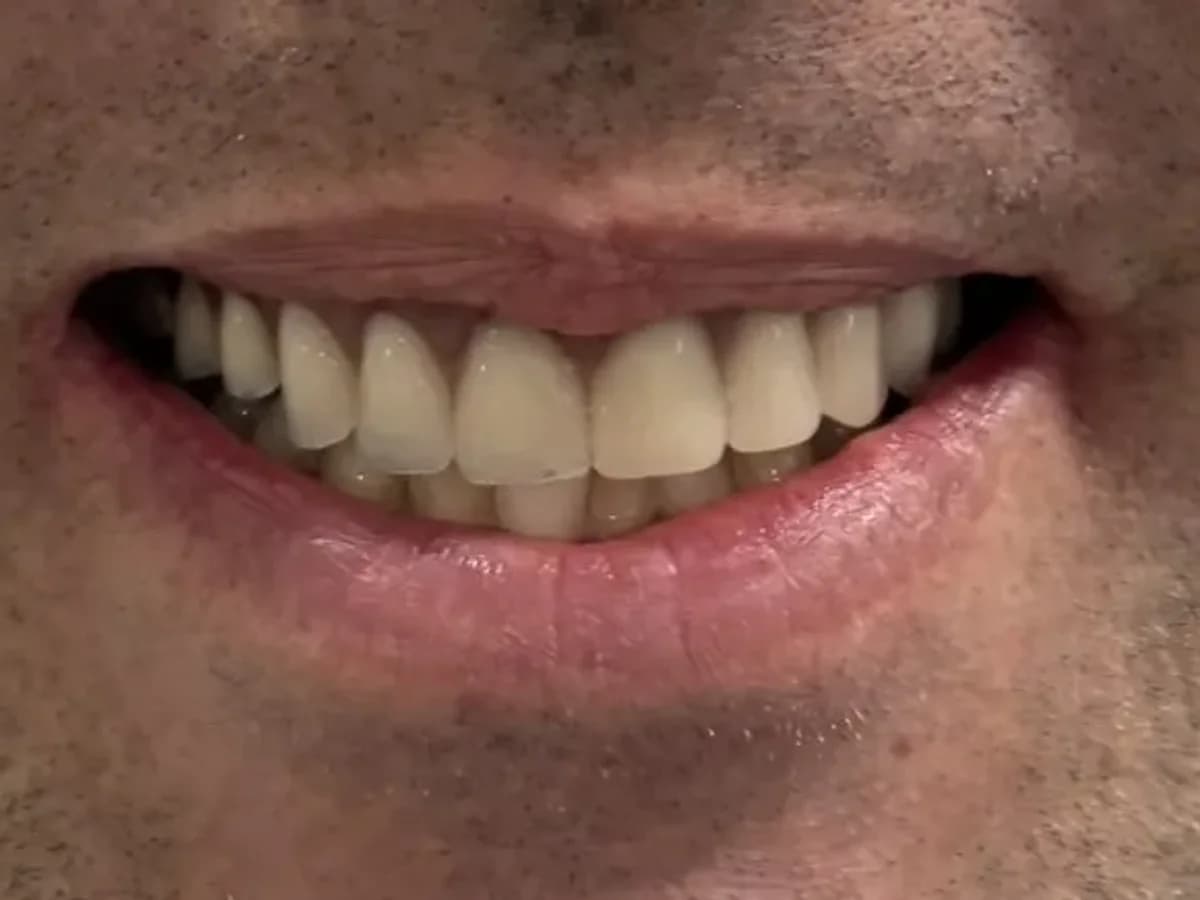 Reabilitação com implantes — Depois